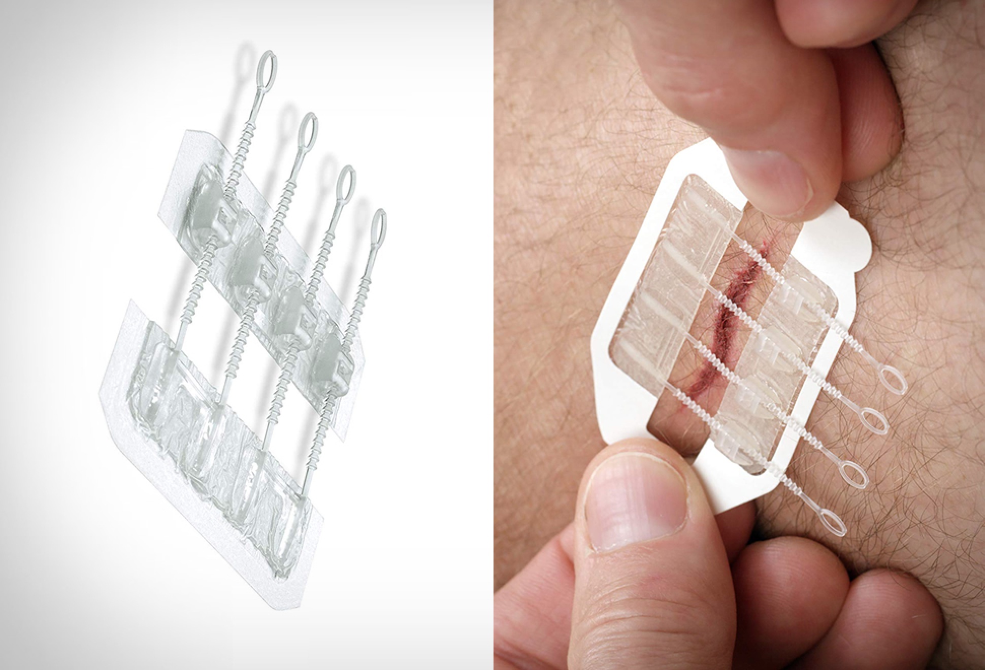 ZipStitch Laceration Kit | Image